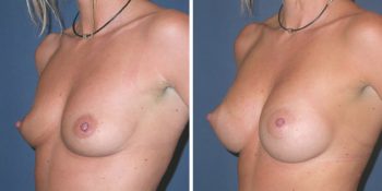 Borstvergroting 250cc