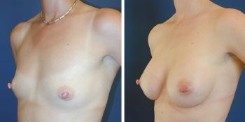 Borstvergroting 270cc