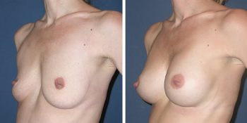 Borstvergroting 280cc