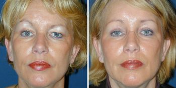 Endoscopische Voorhoofdslift