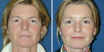 Endoscopische Voorhoofdlift