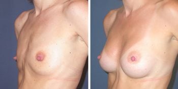 Borstvergroting 280cc