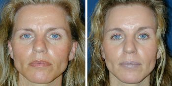 Endoscopische voorhoofdslift