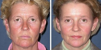 Endoscopische voorhoofdslift