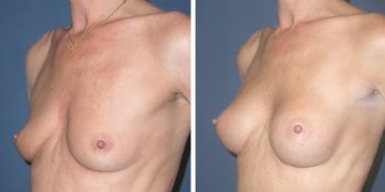 Borstvergroting 190cc