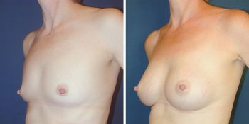 Borstvergroting 245cc