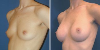 Borstvergroting 270cc