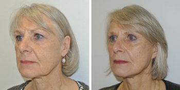 facelift voor en 3 maanden na de operatie uitgevoerd door dr van der weij 10 zijkant links