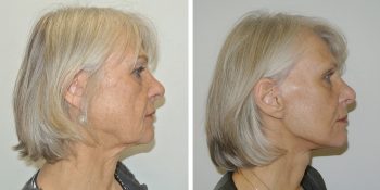 facelift voor en 3 maanden na de operatie uitgevoerd door dr van der weij 10 zijkant