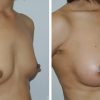 Beautiful borstvergroting voor en na foto Dr van der weij 230 cc anatomische prothese