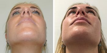 beautiful dr van der weij neuscorrectie voor en na 30 onderkant