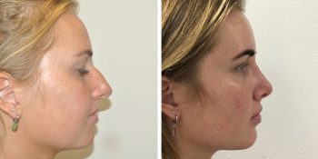 beautiful dr van der weij neuscorrectie voor en na 30 rechter zijkant