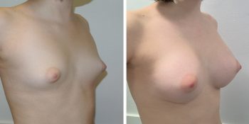 239 Beautiful borstvergroting voor en na foto Dr van der weij 245 cc anatomische prothese rechterzijde