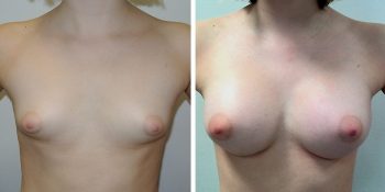 239 Beautiful borstvergroting voor en na foto Dr van der weij 245 cc anatomische prothese voorzijde