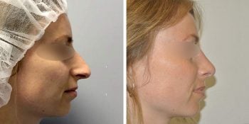 24 beautiful dr van der weij neuscorrectie voor en na rechter zijkant