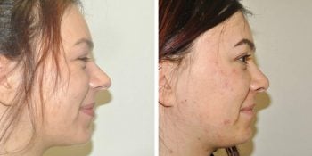 25 beautiful dr van der weij neuscorrectie voor en na rechter zijkant