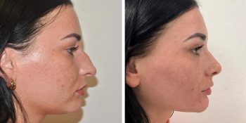 27 beautiful dr van der weij neuscorrectie voor en na rechter zijkant