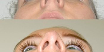 29 beautiful dr van der weij neuscorrectie voor en na rechter onderkant