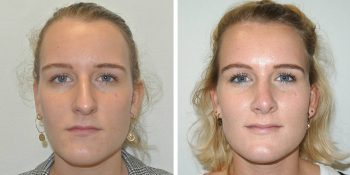 29 beautiful dr van der weij neuscorrectie voor en na voorkant