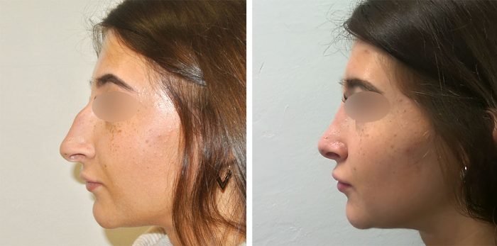 31 beautiful dr van der weij neuscorrectie voor en na linker zijkant