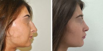 31 beautiful dr van der weij neuscorrectie voor en na rechter zijkant