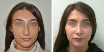 31 beautiful dr van der weij neuscorrectie voor en na voorkant