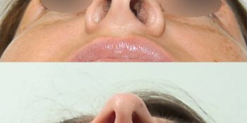 31 beautiful dr van der weij neuscorrectie voor en na onderkant