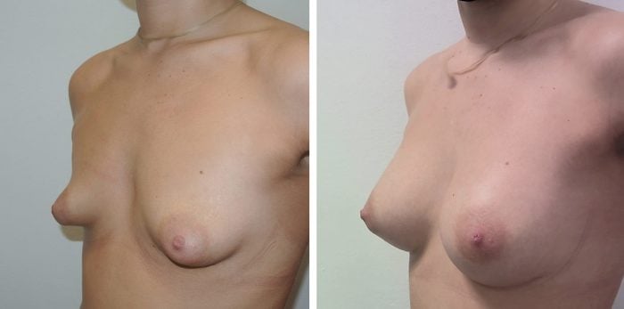 242 Beautiful borstvergroting voor en na foto Dr van der weij 270 cc anatomische prothese linkerzijde