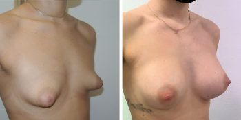 242 Beautiful borstvergroting voor en na foto Dr van der weij 270 cc anatomische prothese rechterzijde