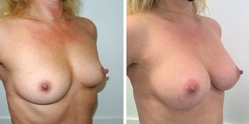 243 Beautiful borstvergroting voor en na foto Dr van der weij 245 cc anatomische prothese rechterrzijde