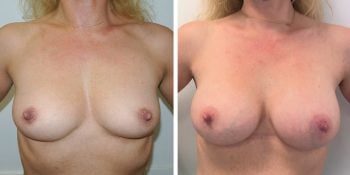 243 Beautiful borstvergroting voor en na foto Dr van der weij 245 cc anatomische prothese voorkant