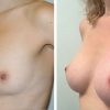 244 Beautiful borstvergroting voor en na foto Dr van der weij 245 cc anatomische prothese linker kant