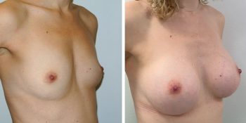 244 Beautiful borstvergroting voor en na foto Dr van der weij 245 cc anatomische prothese rechter kant