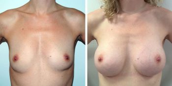 244 Beautiful borstvergroting voor en na foto Dr van der weij 245 cc anatomische prothese voorkant