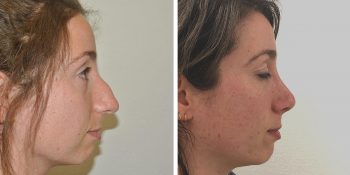 32 beautiful dr van der weij neuscorrectie voor en na rechterzijkant