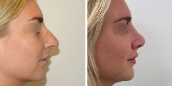 33 beautiful dr van der weij neuscorrectie voor en na rechter zijkant