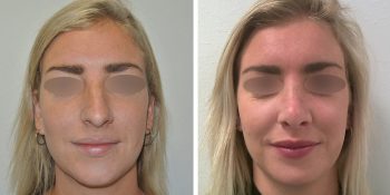 33 beautiful dr van der weij neuscorrectie voor en na voorkant