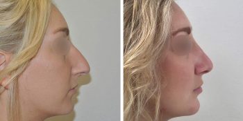 34 beautiful dr van der weij neuscorrectie voor en na rechterzijkant