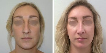 34 beautiful dr van der weij neuscorrectie voor en na voorkant