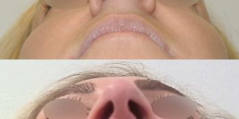 34 beautiful dr van der weij neuscorrectie voor en na onderkant