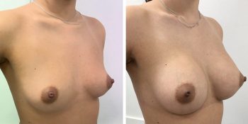 245 Beautiful borstvergroting voor en na foto Dr van der weij 340 cc anatomische prothese rechterkant