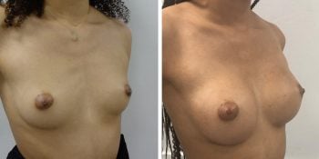 246 Beautiful borstvergroting voor en na foto Dr van der weij 230 cc anatomische prothese rechterkant