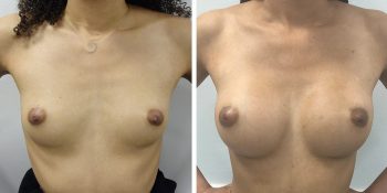 246 Beautiful borstvergroting voor en na foto Dr van der weij 230 cc anatomische prothese voorkant