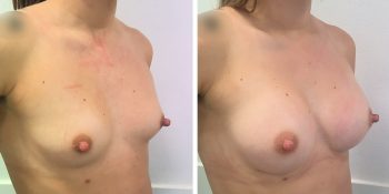 247 Beautiful borstvergroting voor en na foto Dr van der weij 230 cc anatomische prothese rechterkant