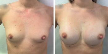 247 Beautiful borstvergroting voor en na foto Dr van der weij 230 cc anatomische prothese voorkant