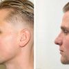 35 beautiful dr van der weij neuscorrectie bij een man voor en na linkerkant