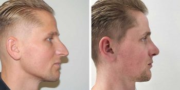 35 beautiful dr van der weij neuscorrectie bij een man voor en na rechterkant