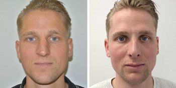 35 beautiful dr van der weij neuscorrectie bij een man voor en na voorkant
