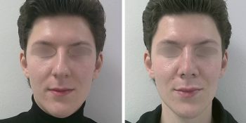36 beautiful dr van der weij neuscorrectie bij een man voor en na voorkant