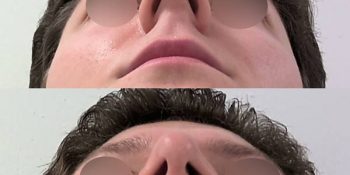 36 beautiful dr van der weij neuscorrectie bij een man voor en na onderkant